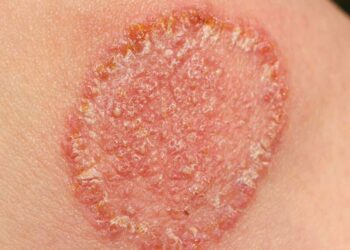 Fungal Infections Workshop – 18 September 2024