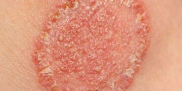 Fungal Infections Workshop – 18 September 2024