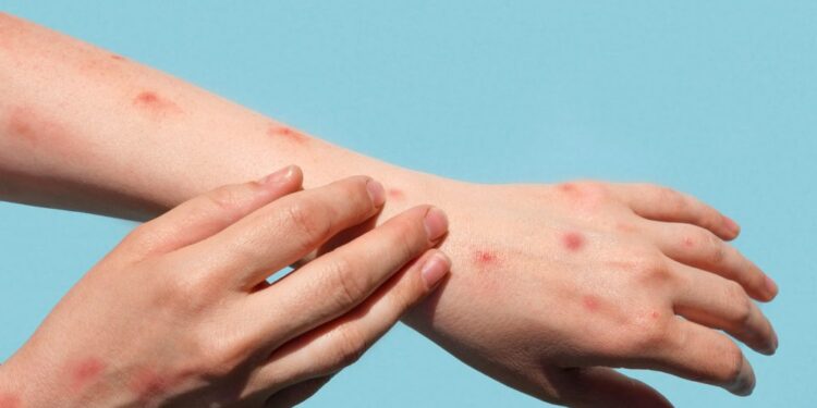 Differential viral causes of vesicular rash in adults with suspected mpox in South Africa